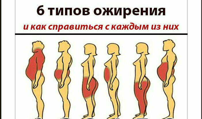 Типы ожирения. Как справиться с каждым из них типы ожирения