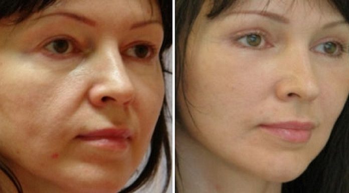 Обвисшие щеки останутся в прошлом