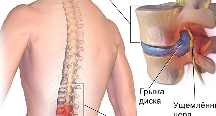 Хирург отговорил меня от операции и посоветовал делать эту зарядку Хирург отговорил меня от операции