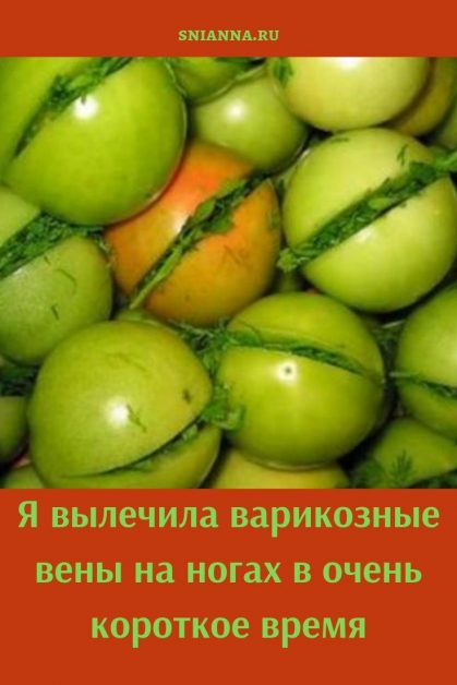 Я вылечила варикозные вены на ногах в очень короткое время