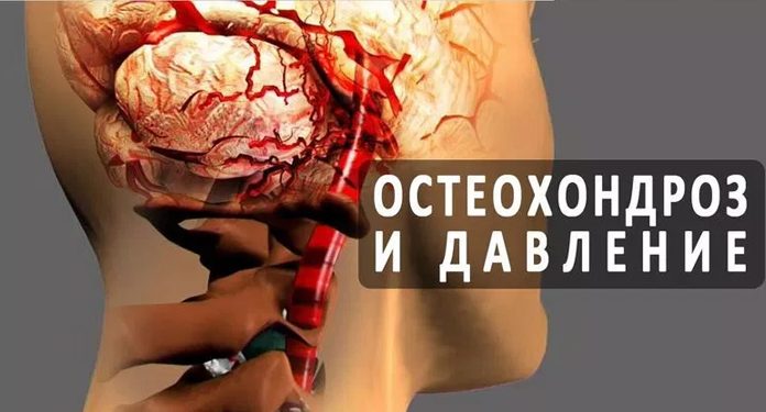 Шейный остеохондроз и высокое давление как неразлучная парочка