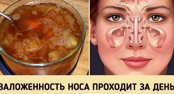 Быстро и просто избавиться от заложенного носа вам поможет этот луковый сироп!