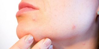 К чему приводят прыщи на разных частях тела