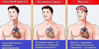 Разница между инфарктом и инсультом 