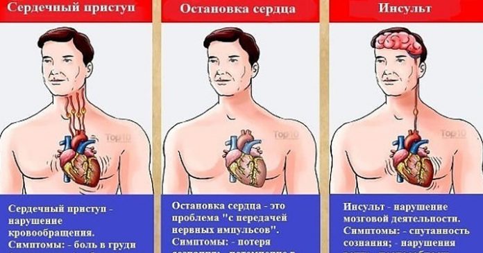 Разница между инфарктом и инсультом Разница между инфарктом и инсультом