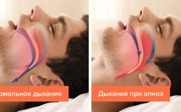 5 признаков того, что вы страдаете от апноэ сна, не понимая этого