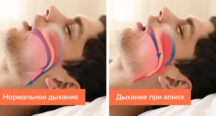 5 признаков того, что вы страдаете от апноэ сна, не понимая этого