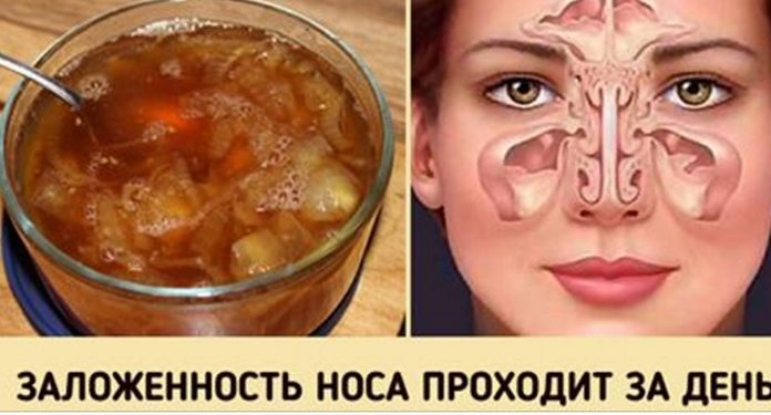 Замечательное средство от заложенного носа. Будете свободно дышать уже на утро!