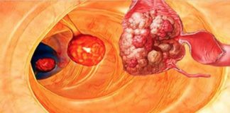 99% болезней, включая рак, можно было бы избежать, если бы люди знали об этом…