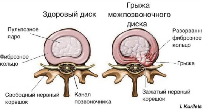 Грыжа диска: вместо операции попробуй это решение