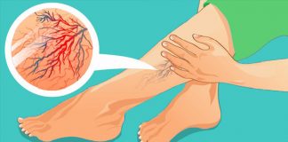 10 прекрасных средств от варикоза