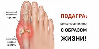 подагра