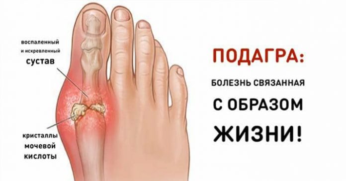 2 подагра