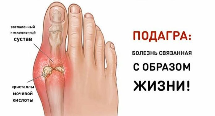 Подагра: болезнь, связанная с образом жизни. Читать каждому! подагра