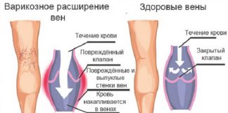 Как лечить варикоз в домашних