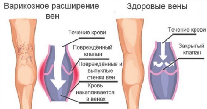 kak-lechit-varikoz Как лечить варикоз в домашних