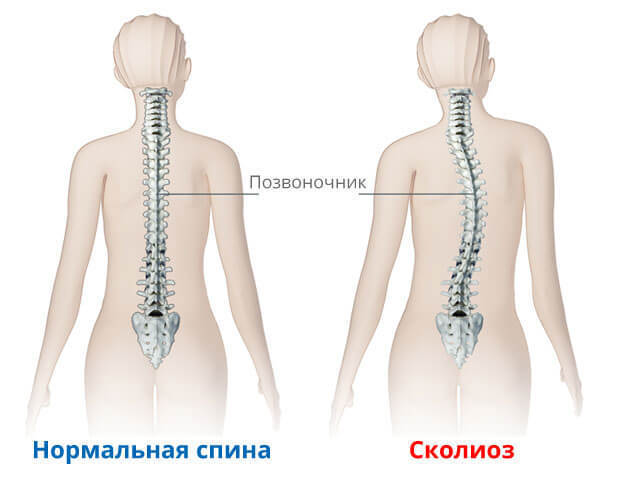 сколиоз